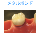 メタルボンド